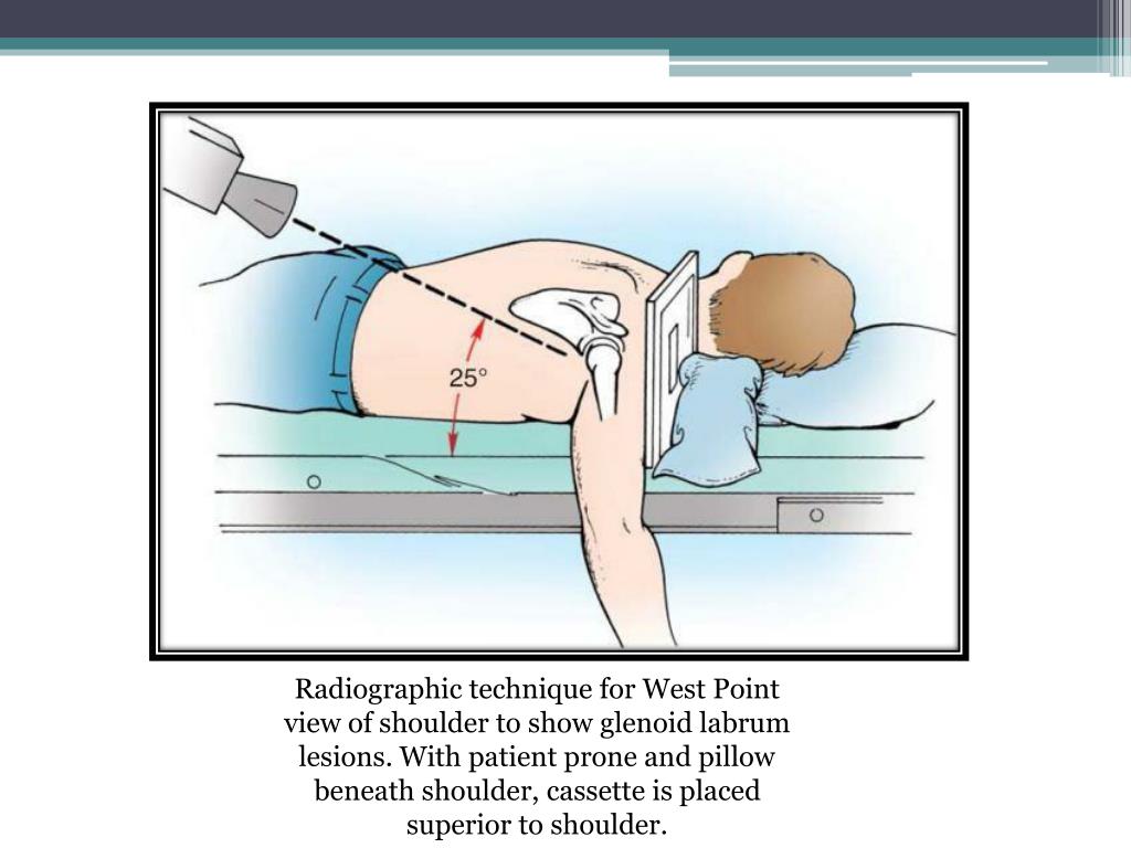 PPT Shoulder Instability PowerPoint Presentation, free download ID