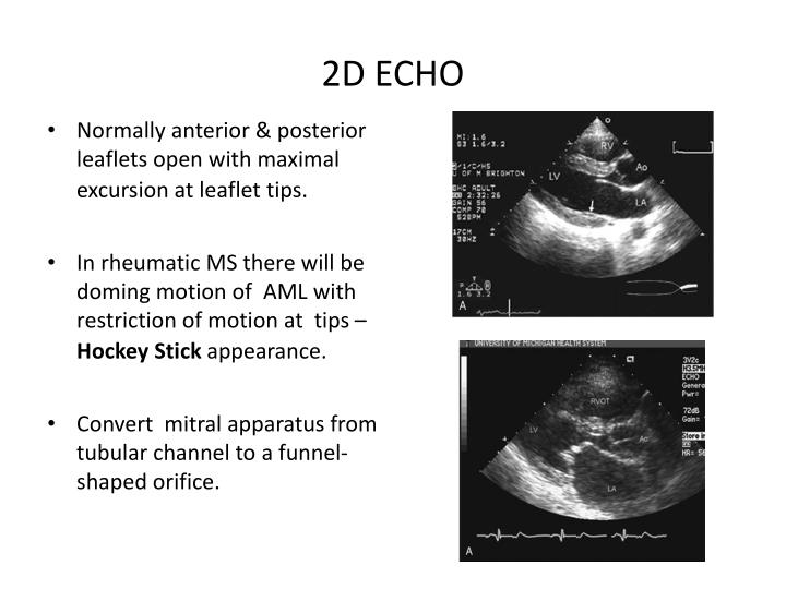 PPT ECHOCARDIOGRAPHIC EVALUATION OF MITRAL STENOSIS PowerPoint