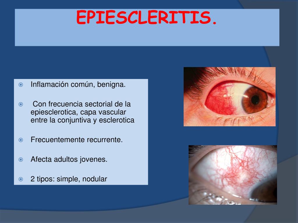 PPT OJO ROJO PowerPoint Presentation, free download ID2203026