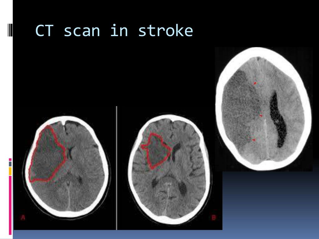 PPT Dr Aaron de Souza MD, DM, DNB, MNAMS Consultant Neurologist