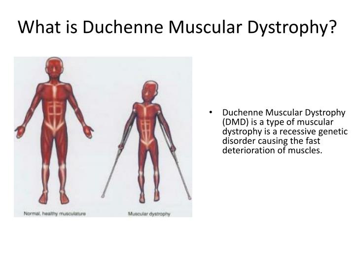 PPT Duchenne Muscular Dystrophy PowerPoint Presentation ID2211783