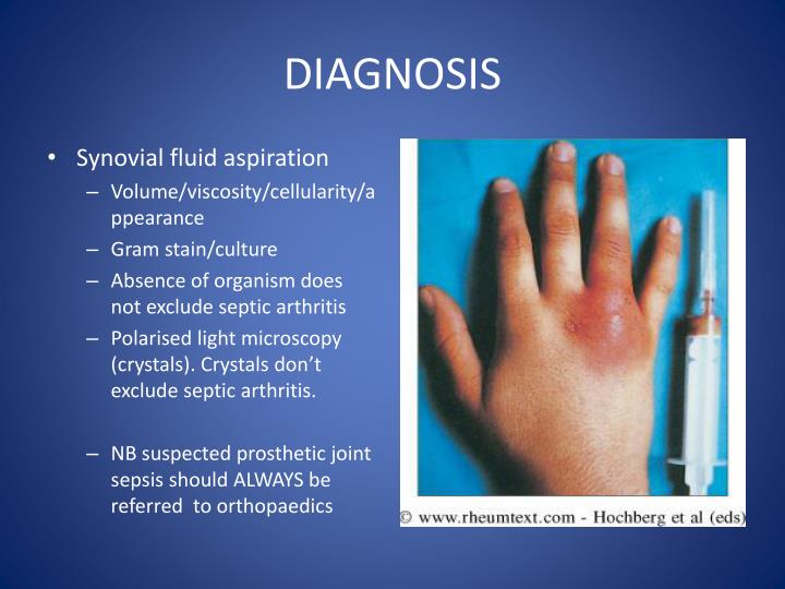 PPT APPROACH TO MONOARTHRITIS PowerPoint Presentation