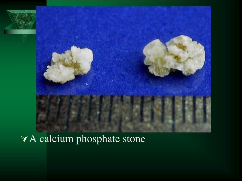 PPT Renal Stone PowerPoint Presentation, free download ID2241273