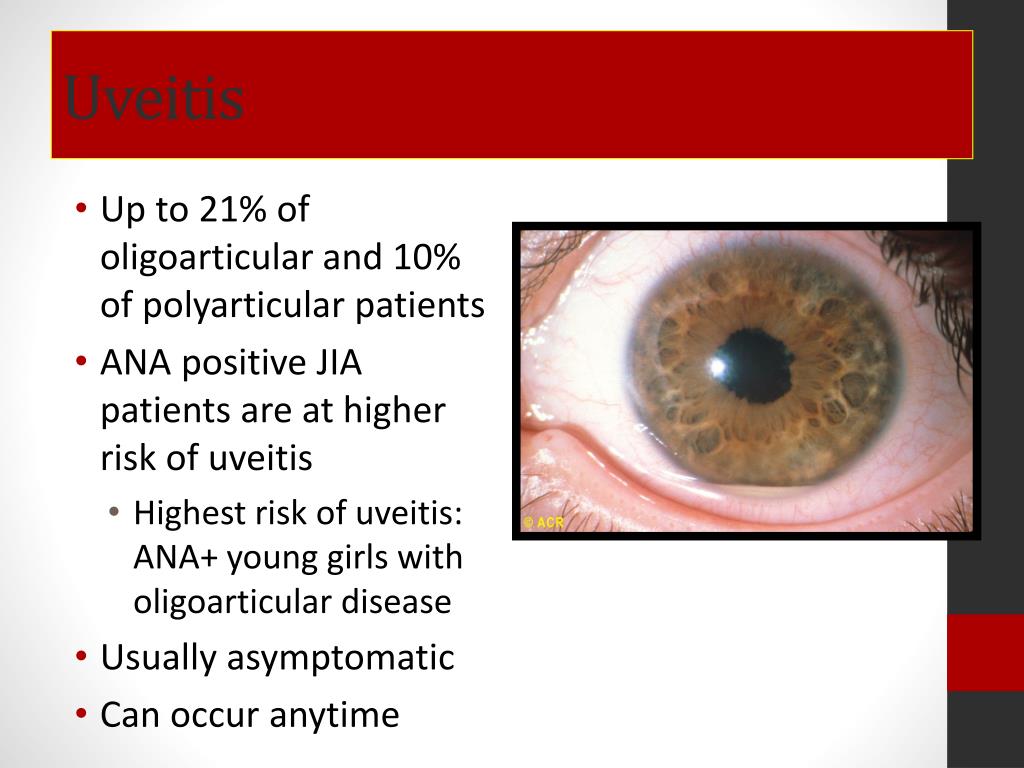 PPT Overview of Juvenile Idiopathic Arthritis PowerPoint Presentation