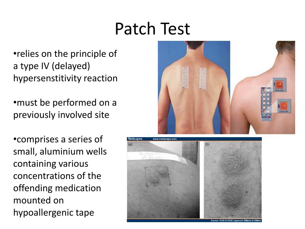 PPT Patch Test PowerPoint Presentation, free download ID2244373