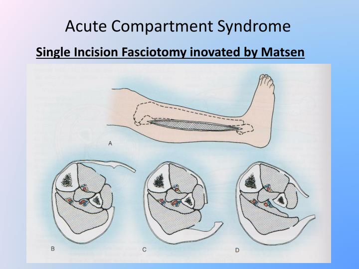 PPT Acute Compartment Syndrome PowerPoint Presentation ID2259539