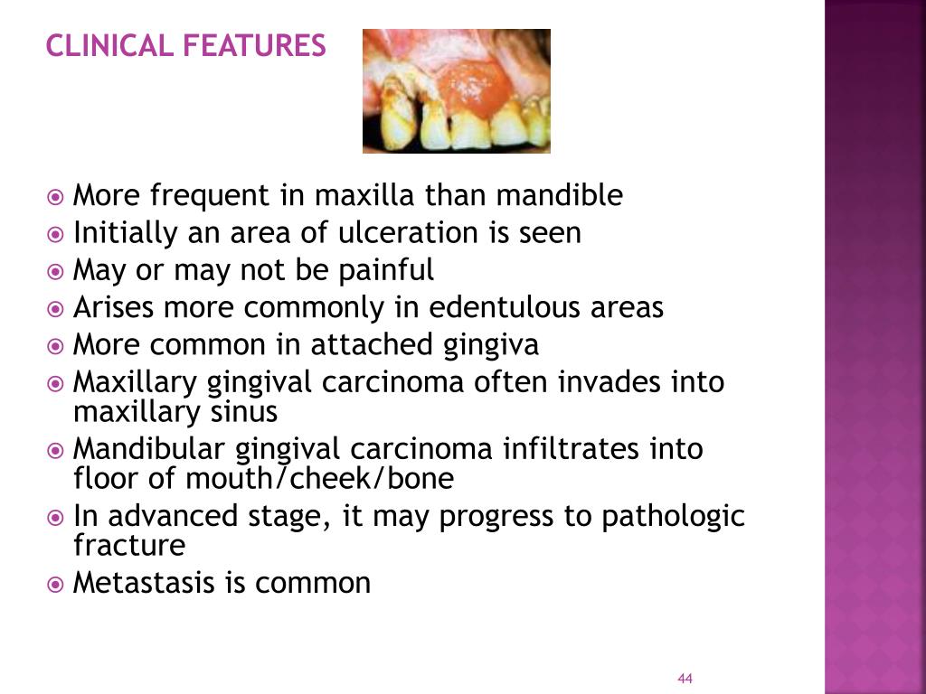 PPT EPIDEMIOLOGY, ETIOLOGY AND PREVENTION OF ORAL CANCER PowerPoint