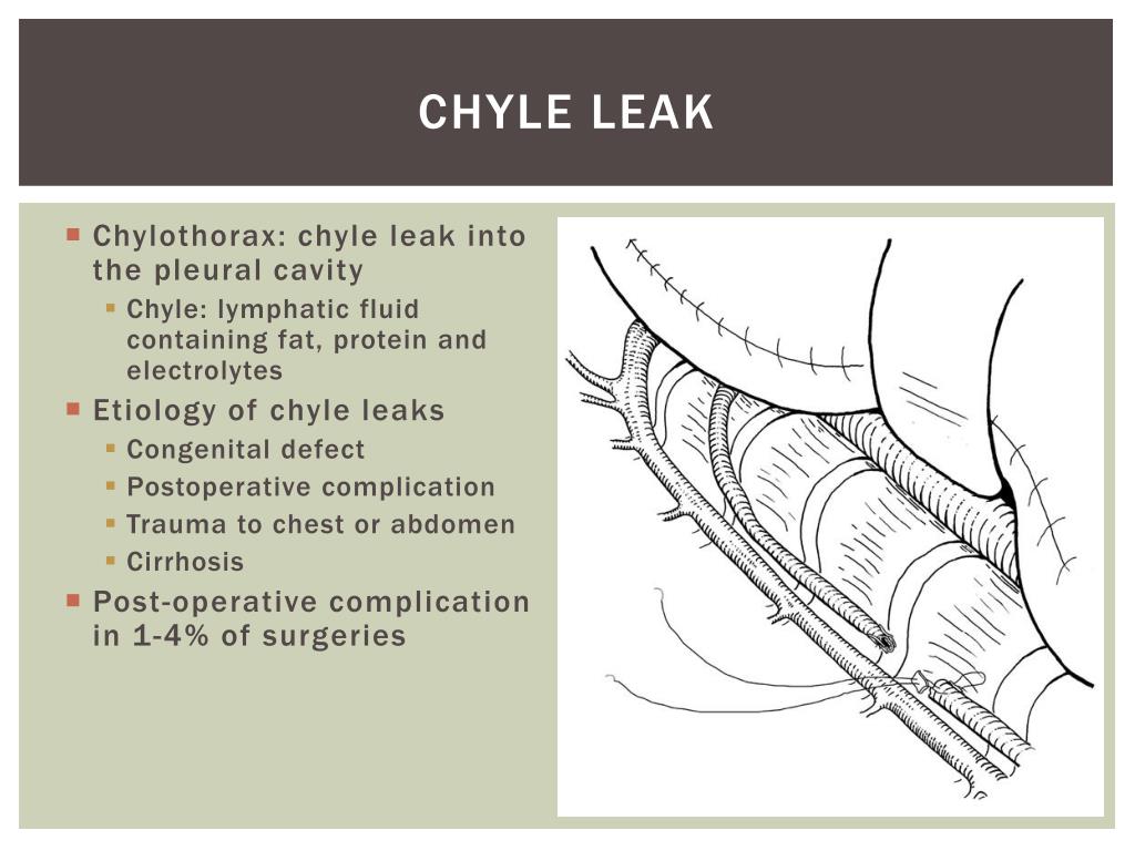 PPT - Chylothorax PowerPoint Presentation, free download - ID:2274201
