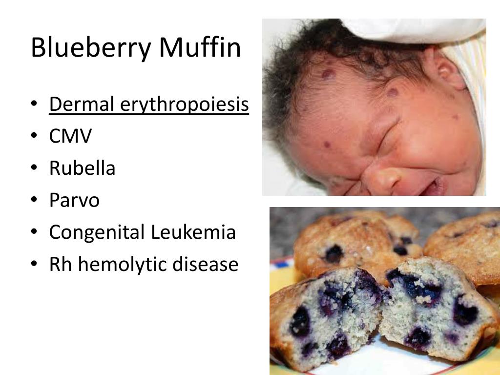 PPT Intrauterine Infection PowerPoint Presentation, free download
