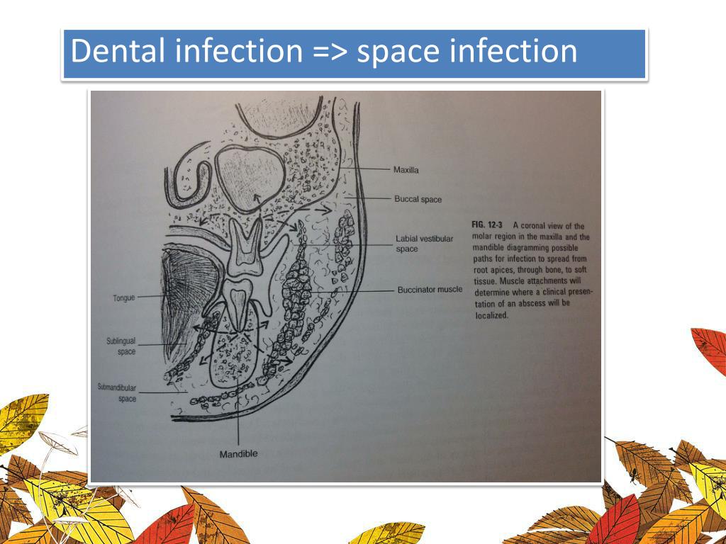 PPT Odontogenic infection in maxillofacial region PowerPoint