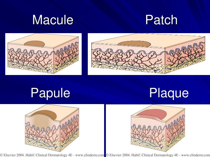 Macule Papule Patch