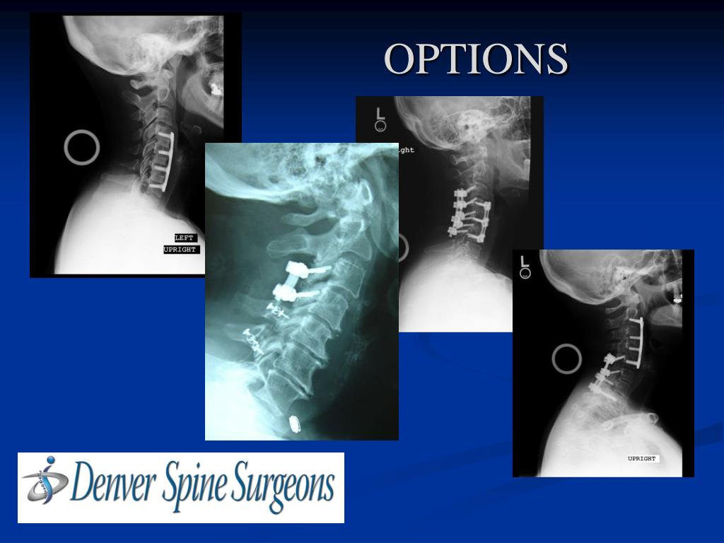 PPT Disc Replacement vs. Fusion Surgery PowerPoint Presentation, free