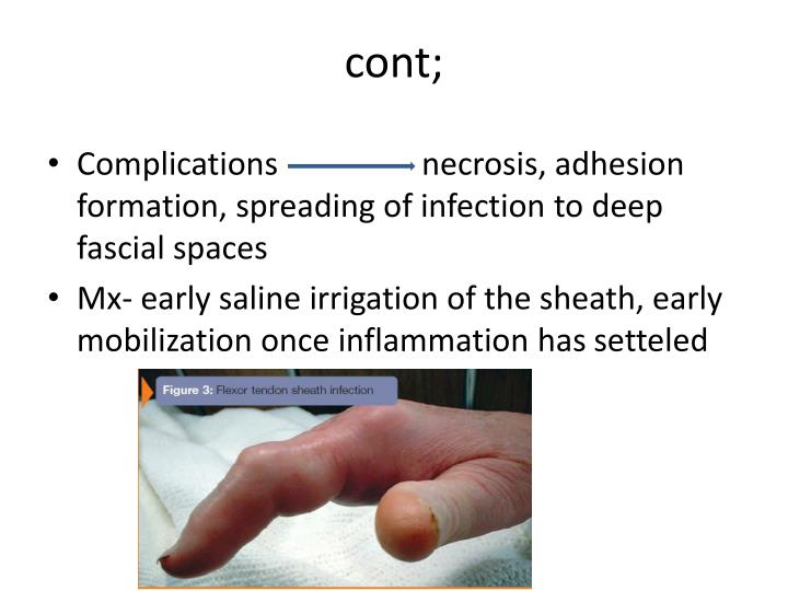 PPT HAND INFECTIONS PowerPoint Presentation ID2323448