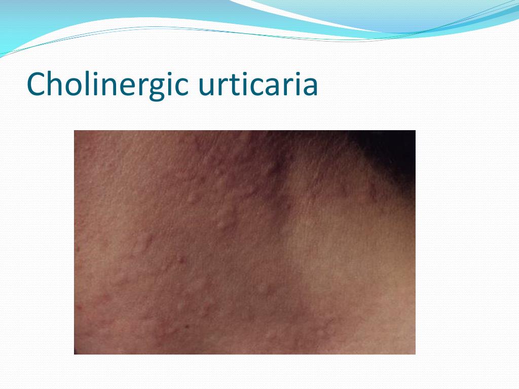 PPT Allergy Urticaria Angioedema Shock anaphylactic