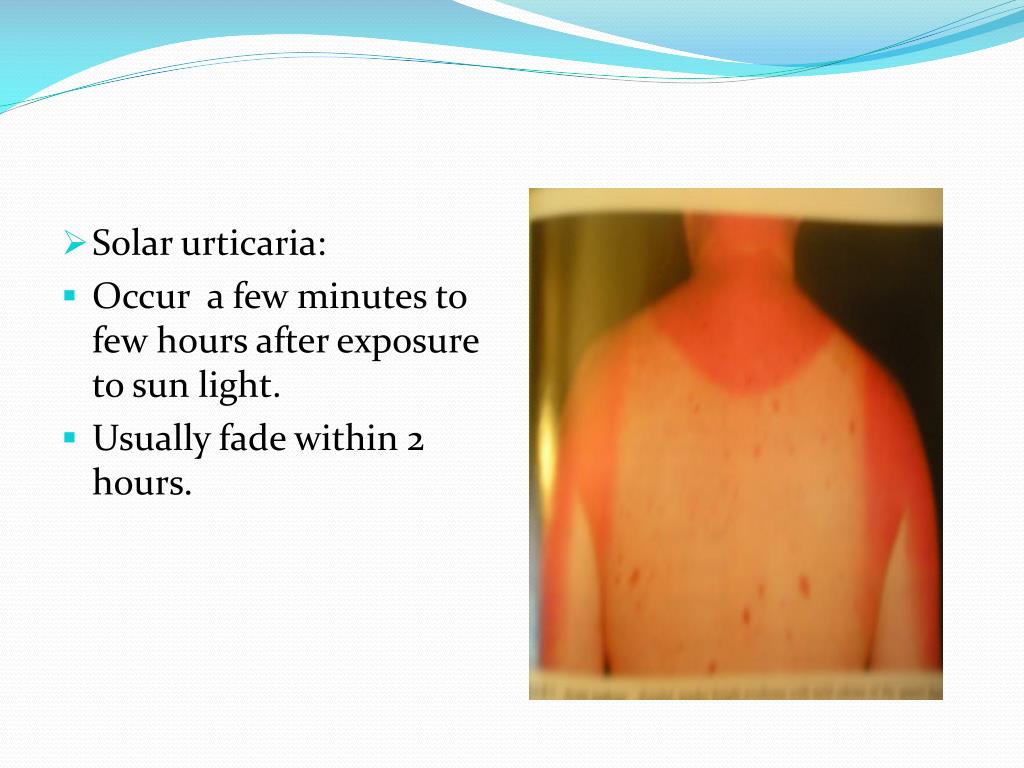 PPT Allergy Urticaria Angioedema Shock anaphylactic PowerPoint