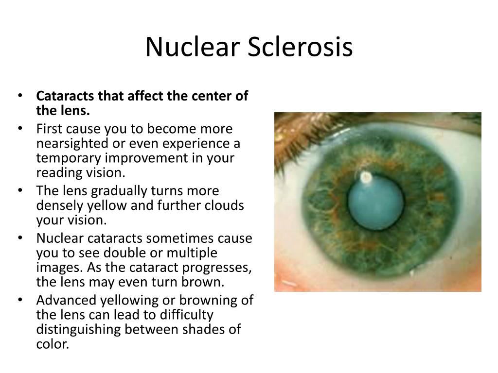 PPT What is a Cataract PowerPoint Presentation, free download ID