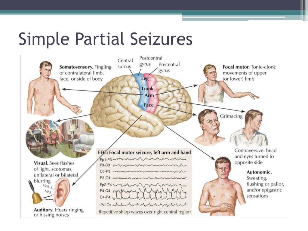 PPT Seizure Disorder The Hidden Disability PowerPoint Presentation ID2340334