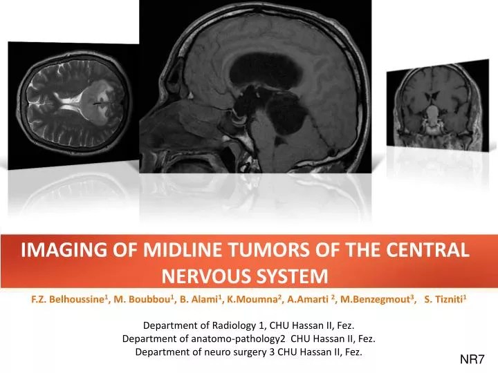 PPT IMAGING OF MIDLINE TUMORS OF THE CENTRAL NERVOUS SYSTEM