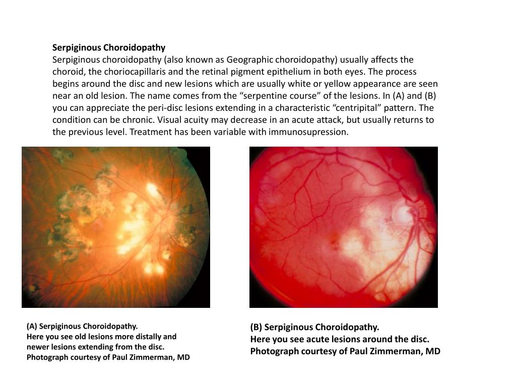 PPT Serpiginous Choroidopathy PowerPoint Presentation, free download ID2361801