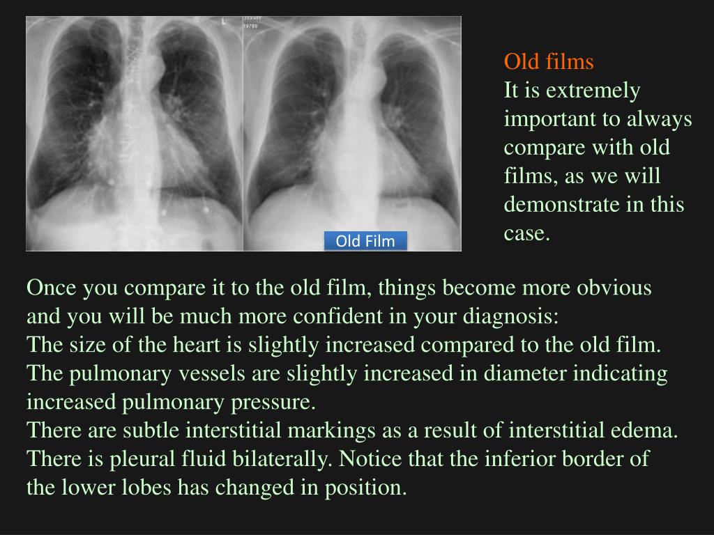 PPT Chest XRay Basic Interpretation PowerPoint Presentation, free