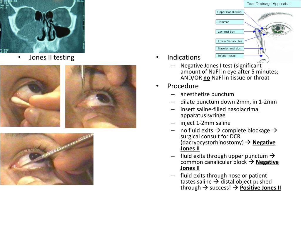 PPT What is needed for diagnosis of dry eye (hint needed to avoid