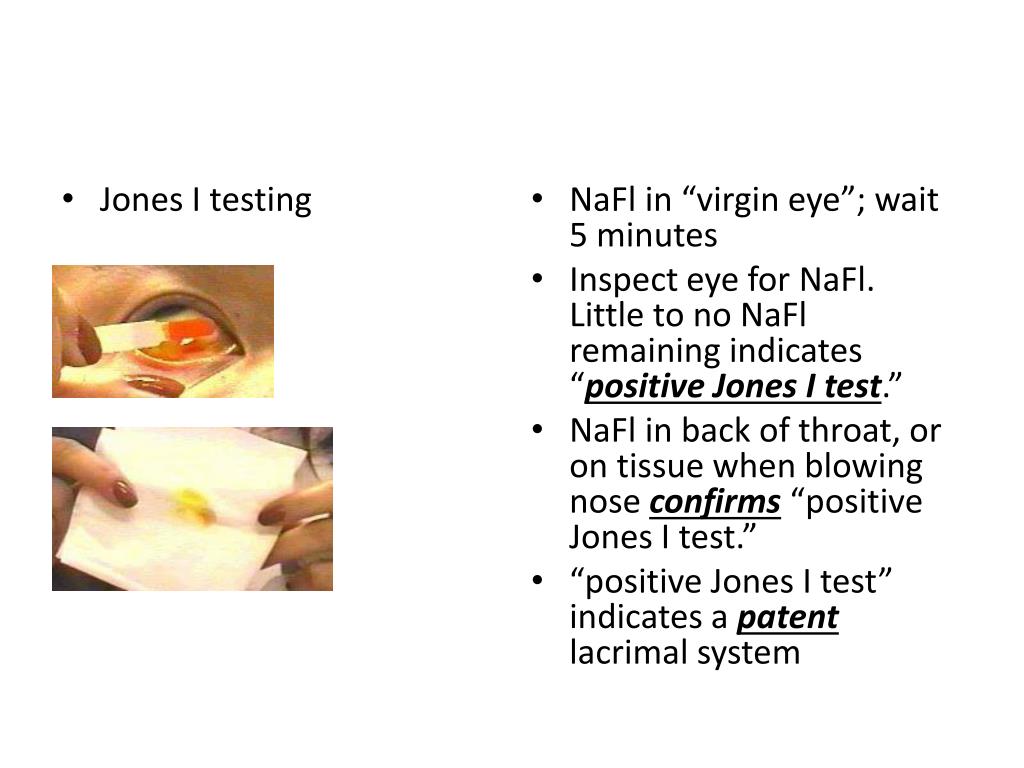 PPT What is needed for diagnosis of dry eye (hint needed to avoid