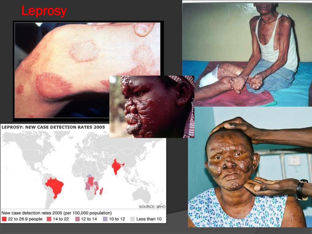 PPT GRANULOMATOUS INFLAMMATION PowerPoint Presentation, free download