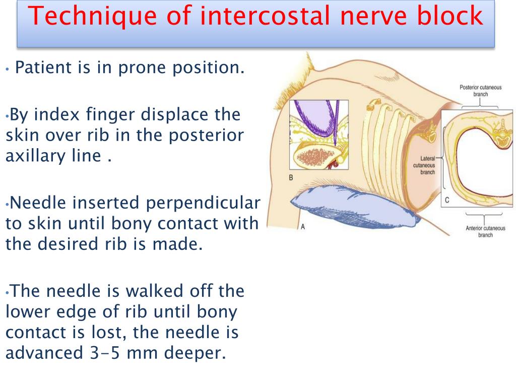 Intercostal Nerve Block Procedure