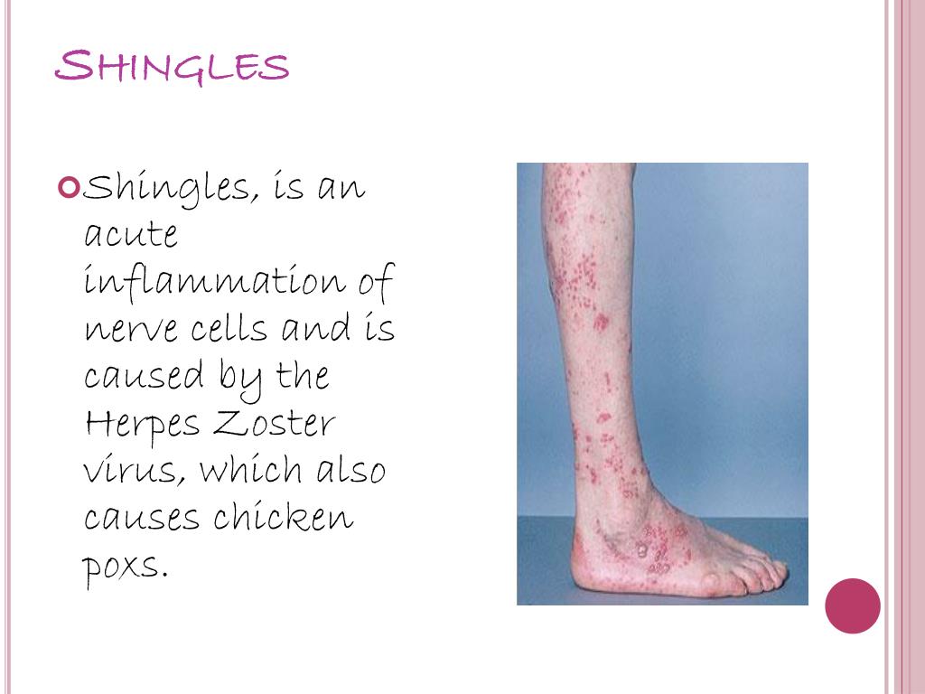 PPT Shingles (Herpes Zoster) PowerPoint Presentation