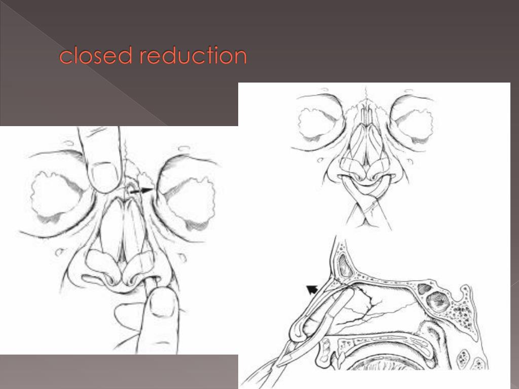 PPT Facial Trauma PowerPoint Presentation, free download