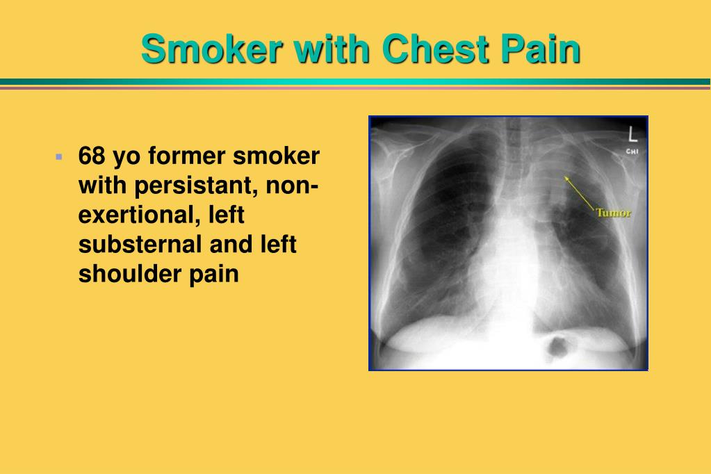 PPT Evaluation of Chest Pain in the Emergency Department