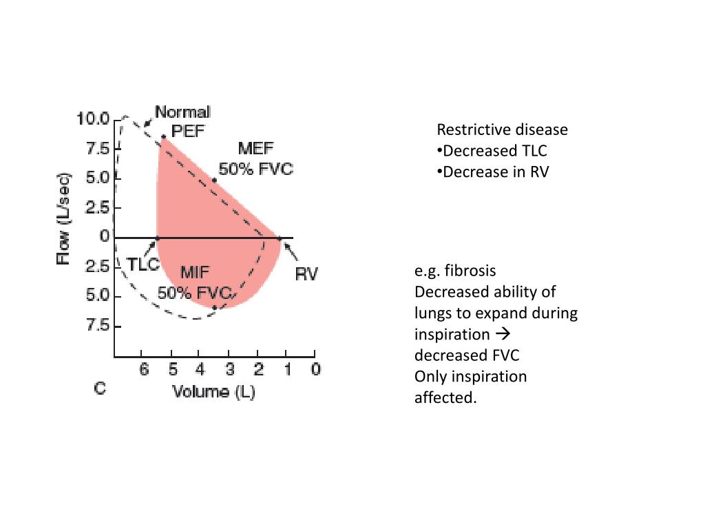 PPT Cystic Fibrosis Bronchiectasis Bilateral diffuse Multiple