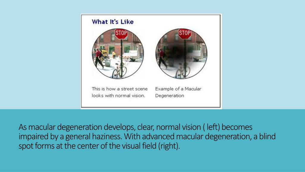 PPT Macular Degeneration Adult and Juvenile PowerPoint Presentation