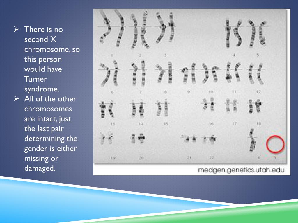 PPT Turner syndrome PowerPoint Presentation, free download ID2452826