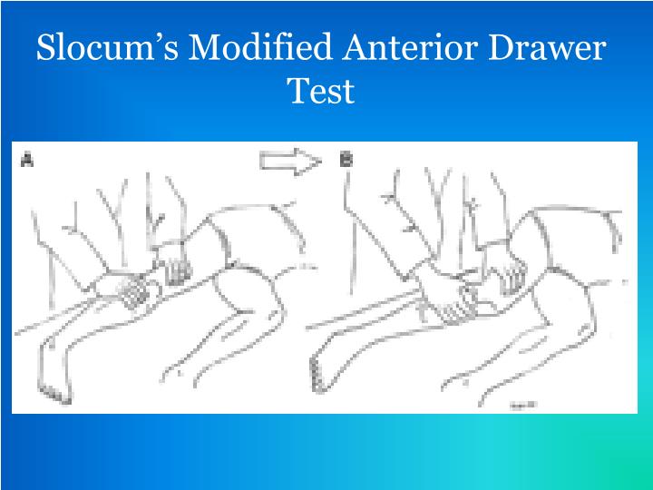 PPT Medial Collateral Ligament (MCL) Tear PowerPoint Presentation