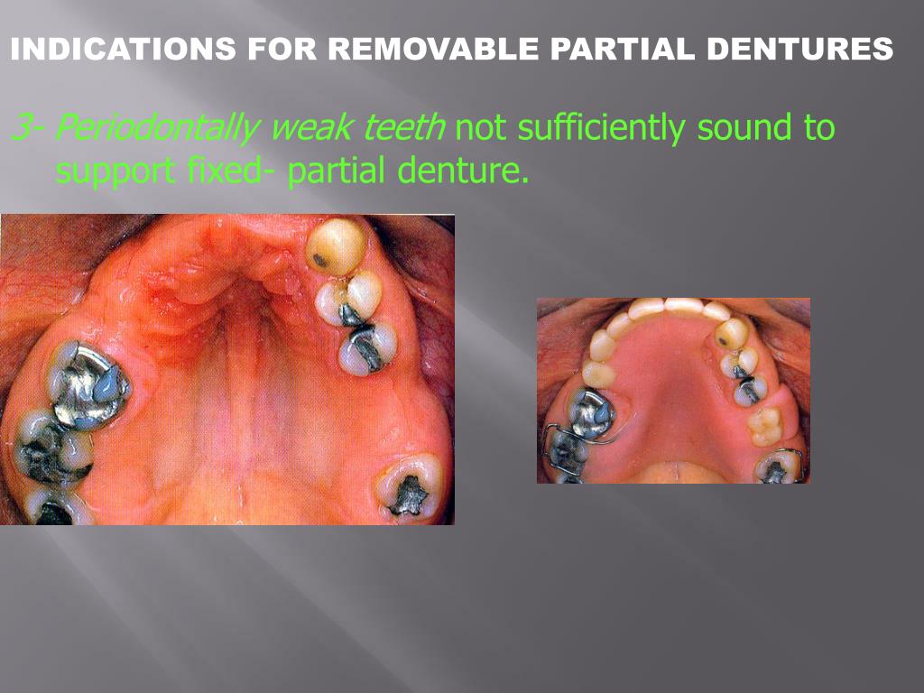 PPT REMOVABLE PARTIAL DENTURES PowerPoint Presentation, free download ID2484276