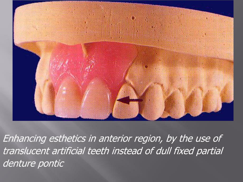 PPT REMOVABLE PARTIAL DENTURES PowerPoint Presentation, free download ID2484276