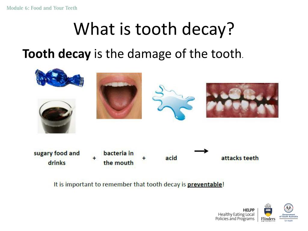 PPT What is tooth decay? PowerPoint Presentation, free