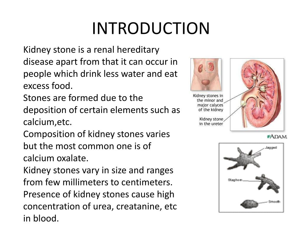 PPT Kidney Stones PowerPoint Presentation, free download ID2515761