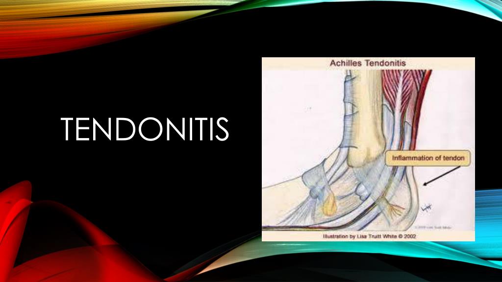 PPT Tendonitis PowerPoint Presentation, free download ID2523395