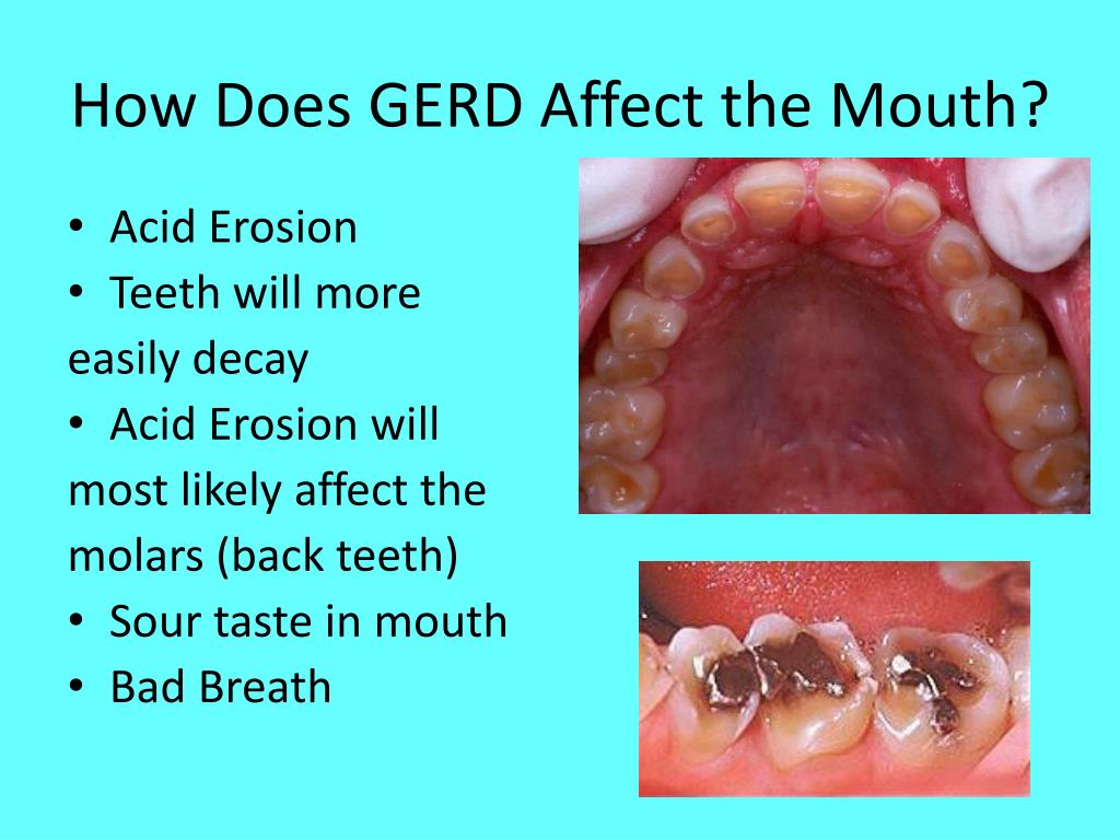 Can Acid Reflux Affect Smell And Taste at Michael Townsend blog