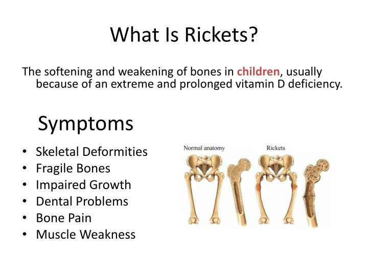 PPT Rickets Disease PowerPoint Presentation ID2568458