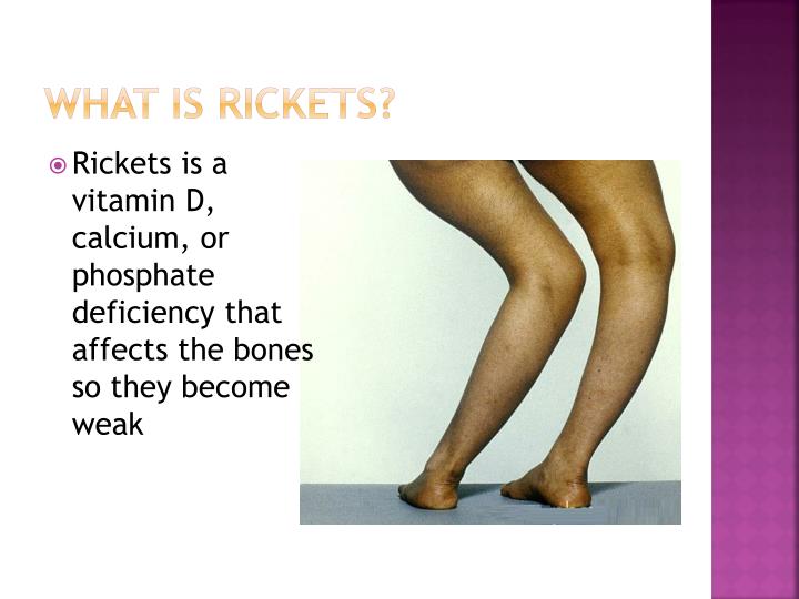 PPT Rickets PowerPoint Presentation ID2568522