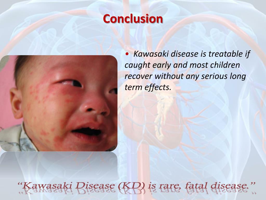 PPT What is Kawasaki Disease? PowerPoint Presentation, free download