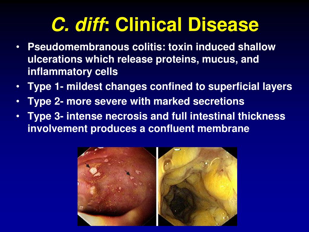 PPT Clostridium Difficile Epidemiology and Clinical Spectrum