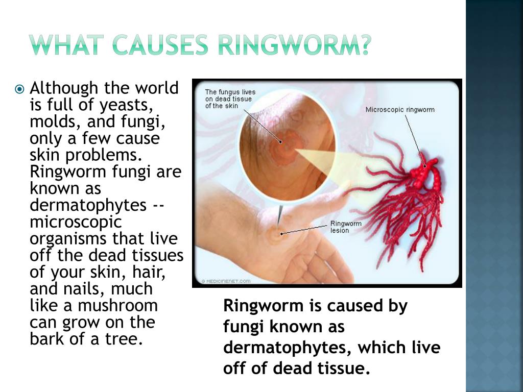 PPT Ringworm PowerPoint Presentation, free download ID2634085