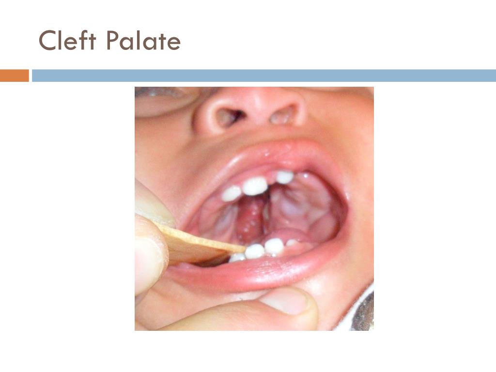 PPT Cleft Palate and Lip PowerPoint Presentation, free download ID
