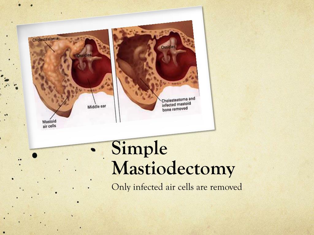 PPT Mastoidectomy PowerPoint Presentation, free download ID2691521