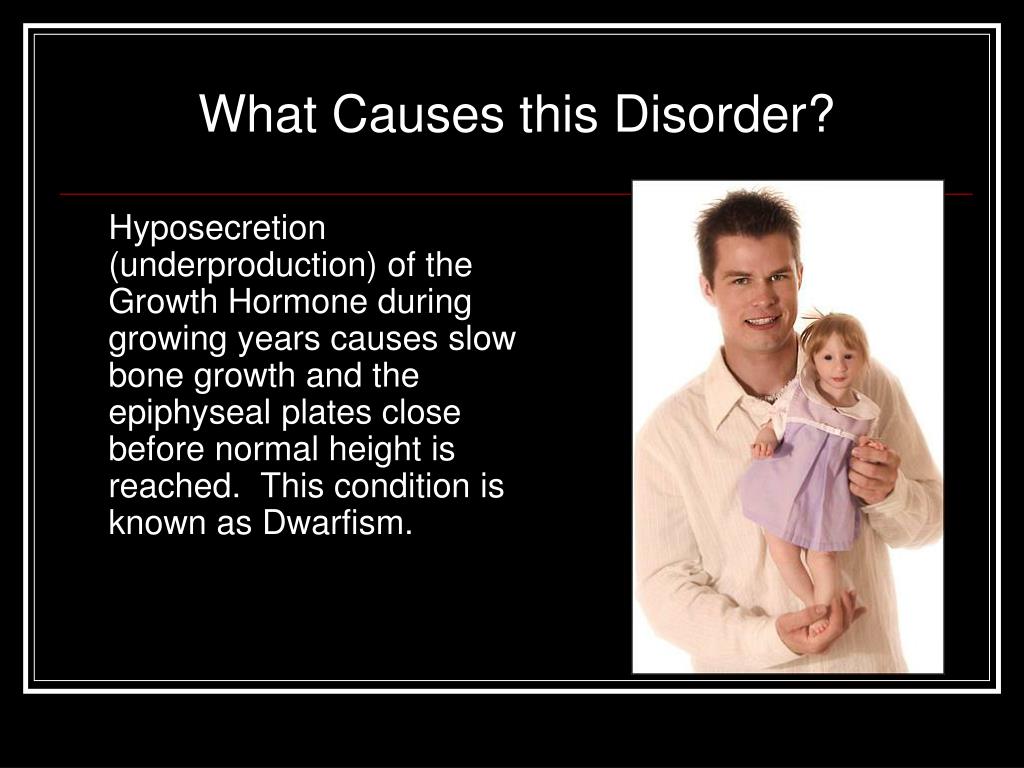 PPT Pituitary DWARFISM PowerPoint Presentation, free