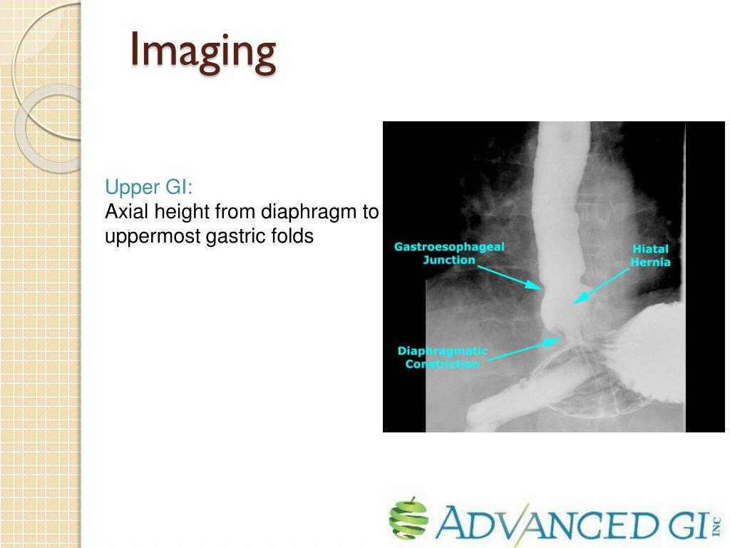 PPT Endoscopic Diagnosis of Hiatal Hernia PowerPoint Presentation
